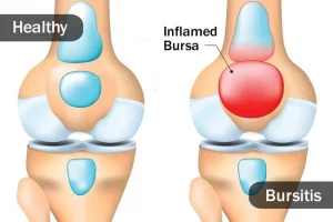 Bursitis