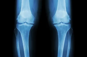 xray knees