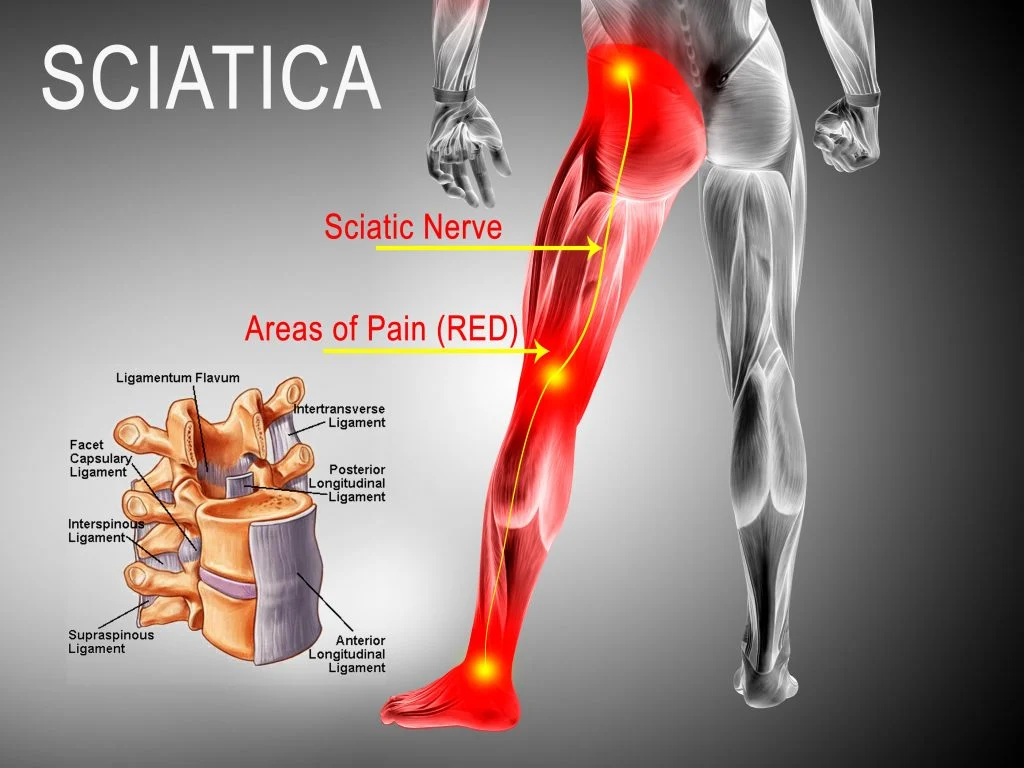 https://www.bioxcellerator.com/wp-content/uploads/2023/02/sciatica-pain-colorado-pain-care-blog.webp
