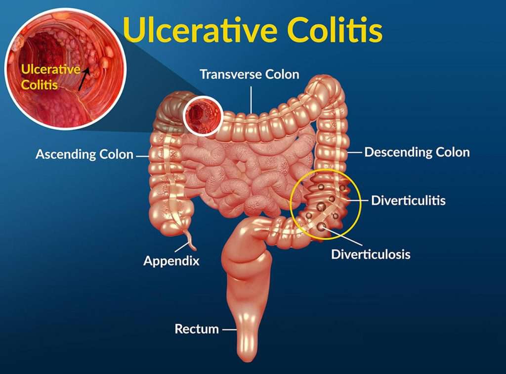 Ulcerative Colitis Treatment with Stem Cells - BioXcellerator