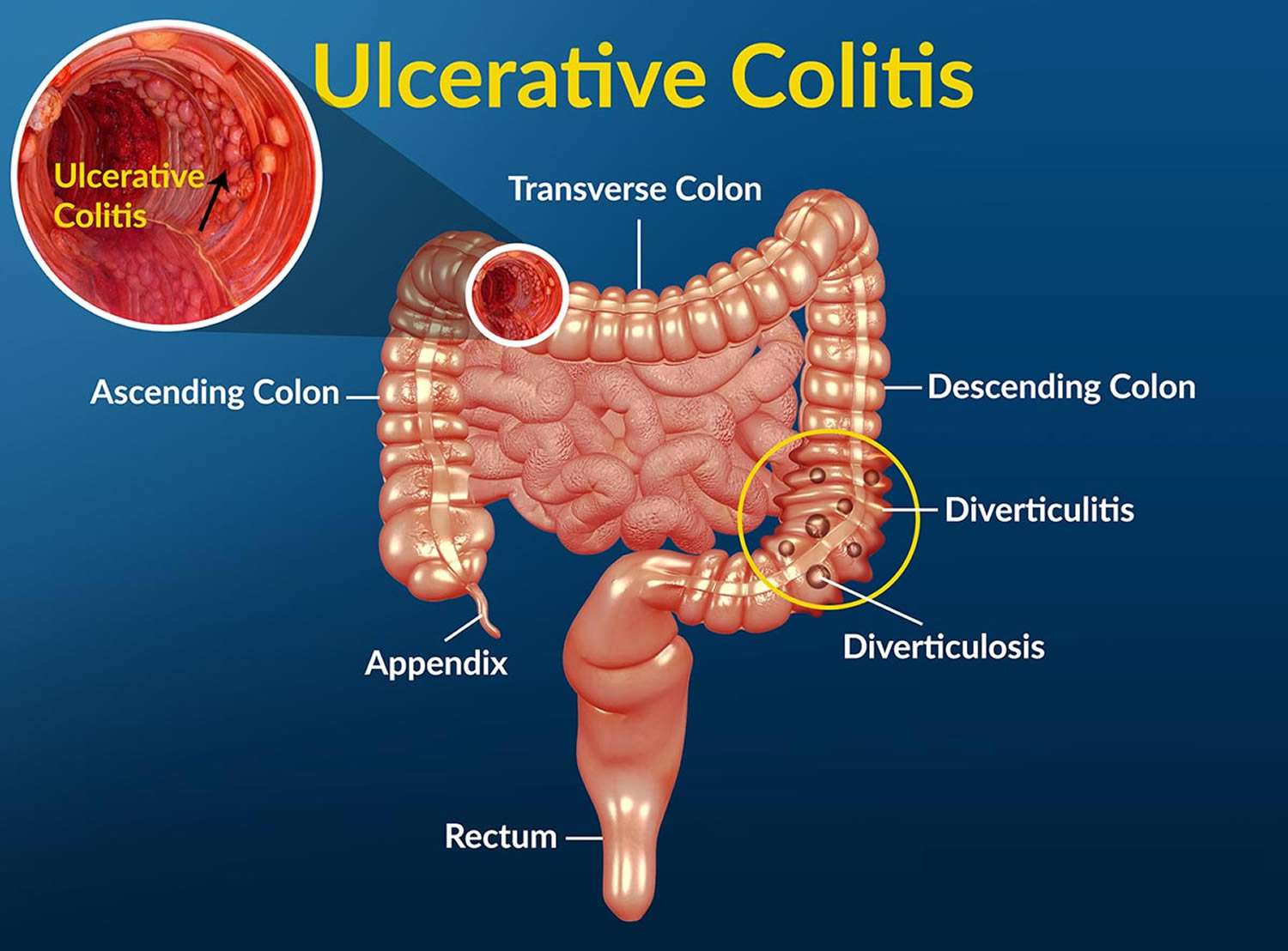 What is Ulcerative Colitis - International Gastro Institute